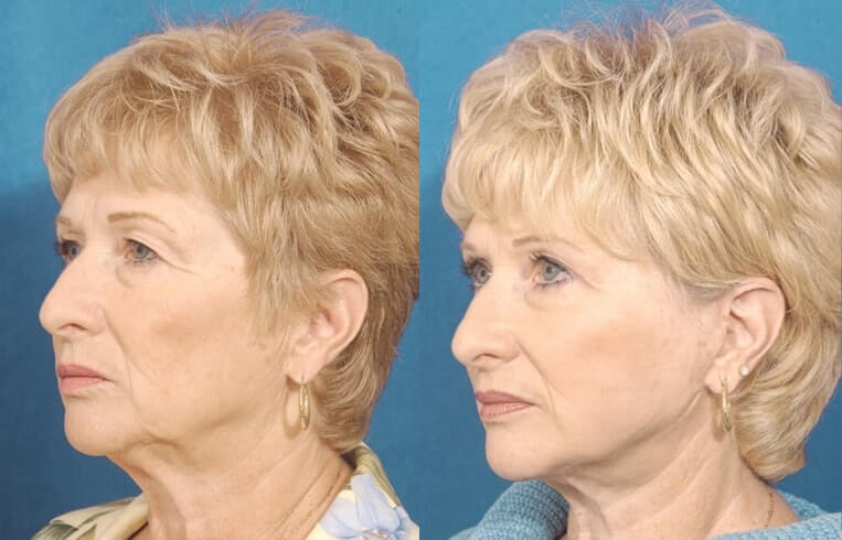 Blepharoplasty