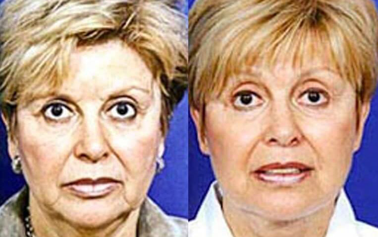 Blepharoplasty