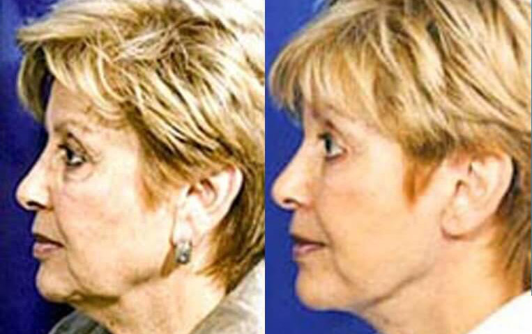 Blepharoplasty