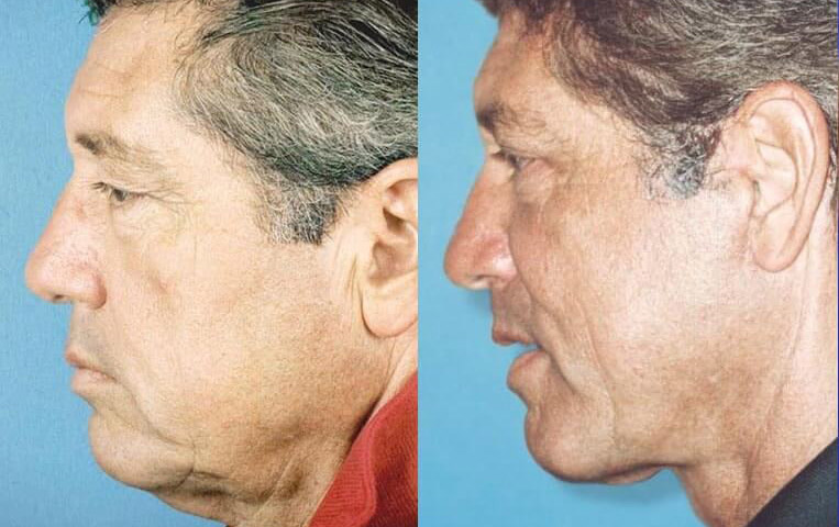 Blepharoplasty