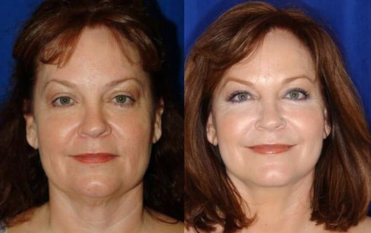 Blepharoplasty