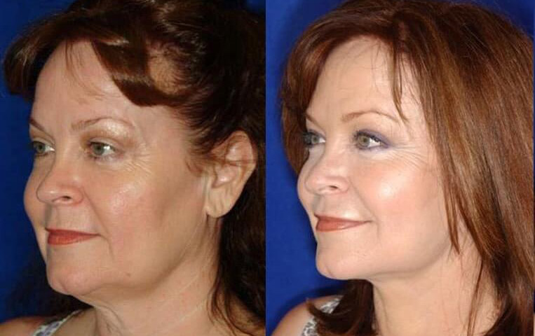 Blepharoplasty