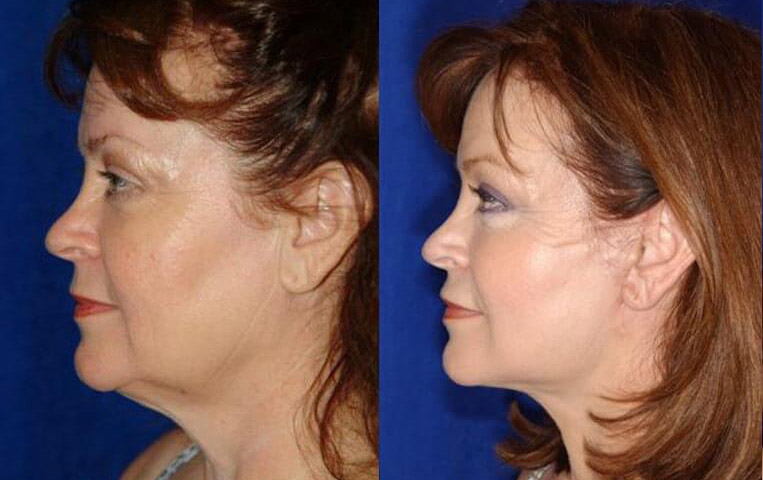 Blepharoplasty