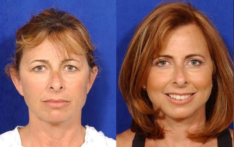 Blepharoplasty