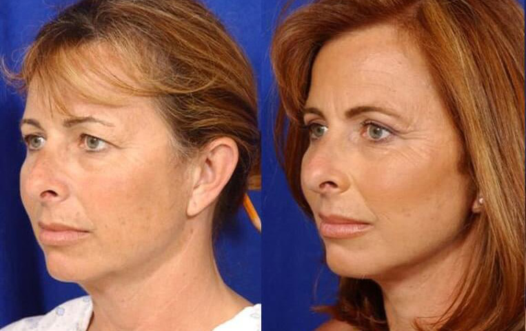 Blepharoplasty