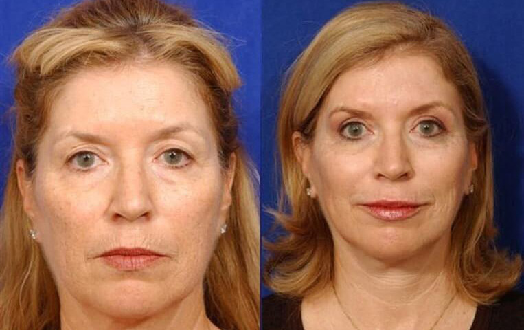 Blepharoplasty