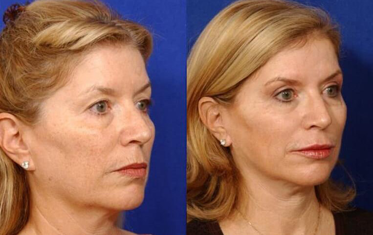 Blepharoplasty