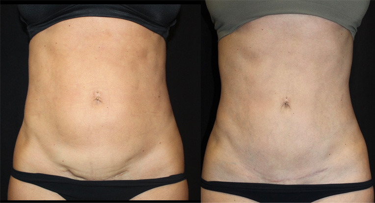 Post Op: 7months, Hybrid Tummy Tuck, Umbilical Hernia Repair