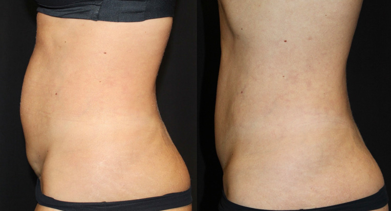 Post Op: 7months, Hybrid Tummy Tuck, Umbilical Hernia Repair