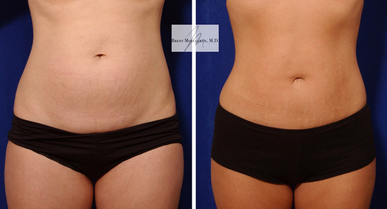 Hybrid Tummy Tuck