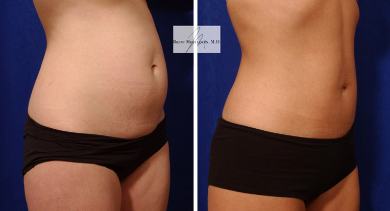 Hybrid Tummy Tuck