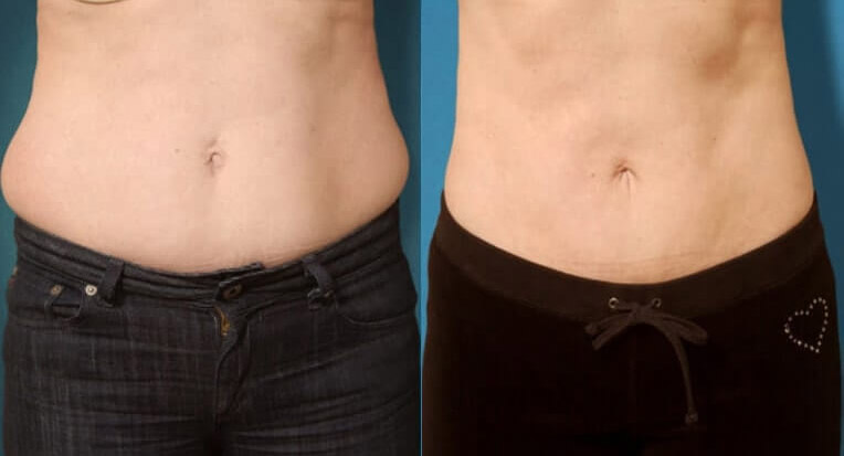 Hybrid abdominoplasty tummy tuck with liposculpture of flanks.