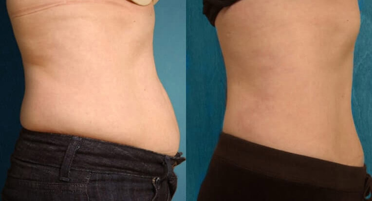 Hybrid abdominoplasty tummy tuck with liposculpture of flanks.