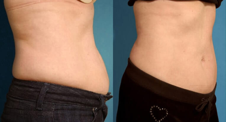 Hybrid abdominoplasty tummy tuck with liposculpture of flanks.