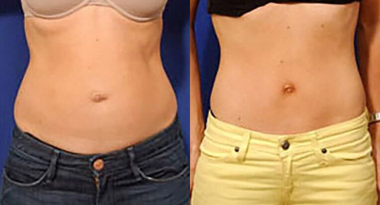 Hybrid abdominoplasty with liposculpture of flanks.