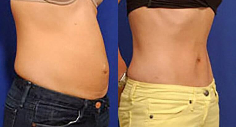 Hybrid abdominoplasty with liposculpture of flanks.