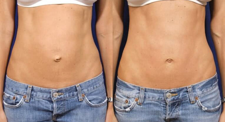 Hybrid abdominoplasty tummy tuck with liposculpture of flanks.