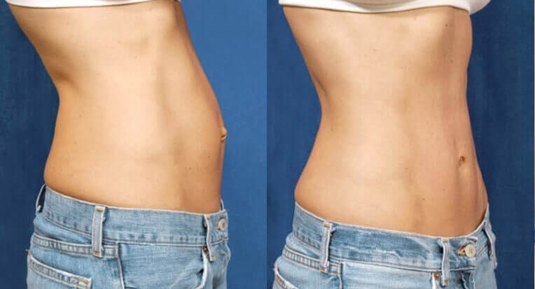 Hybrid abdominoplasty tummy tuck with liposculpture of flanks.