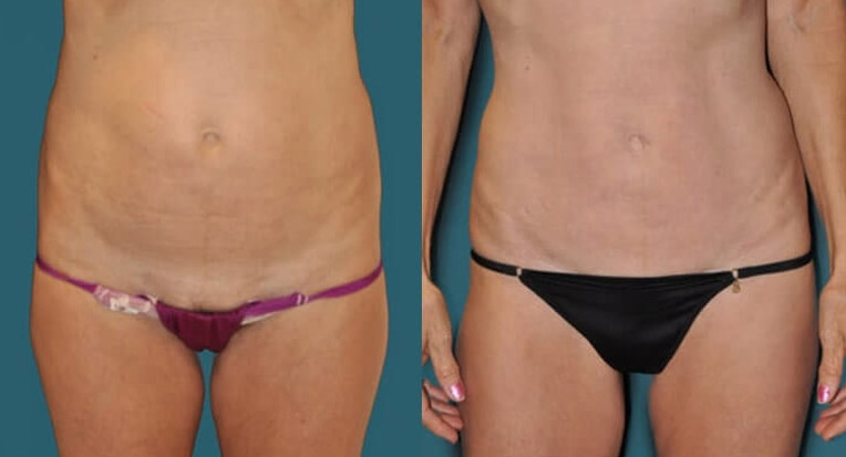 Hybrid abdominoplasty tummy tuck