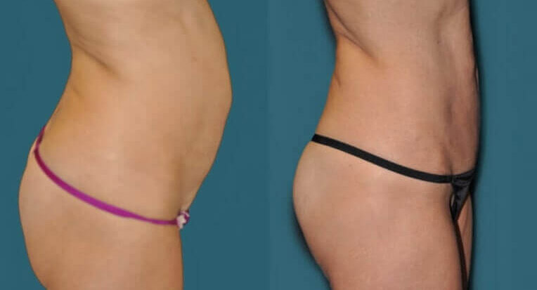 Hybrid abdominoplasty tummy tuck