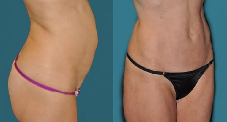 Hybrid abdominoplasty tummy tuck