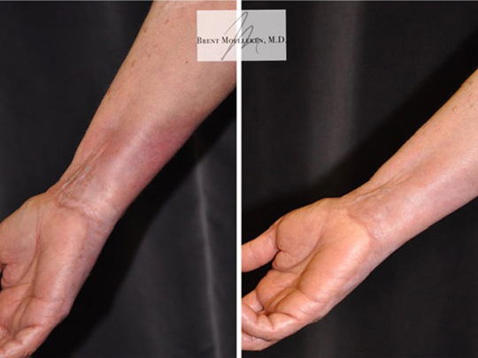 Burns to hand and wrist Post 8 AFT Laser Treatments