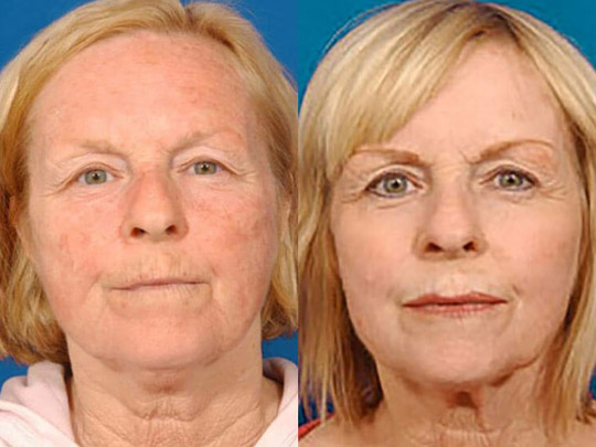 Laser Skin Resurfacing