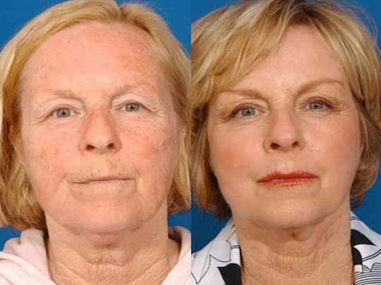 Laser Skin Resurfacing