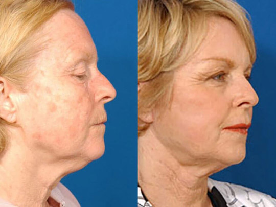 Laser Skin Resurfacing