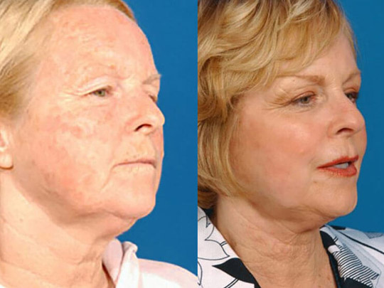 Laser Skin Resurfacing