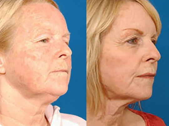 Laser Skin Resurfacing