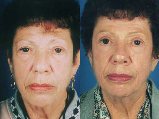 Cheeklift, blepharoplasty and CO2 laser resurfacing.