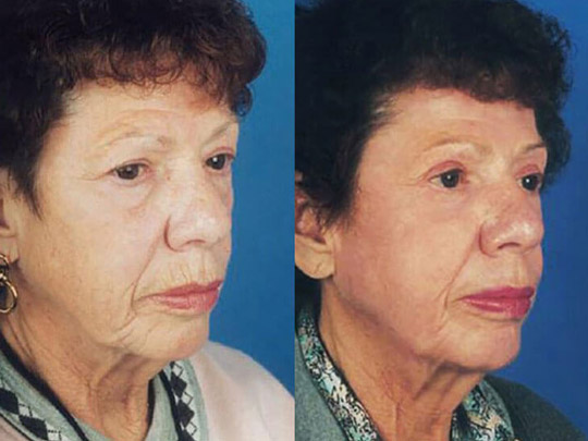 Cheeklift, blepharoplasty and CO2 laser resurfacing.