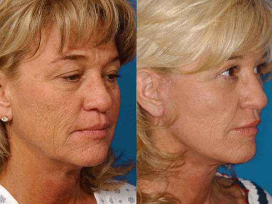 Facelift with Neck-lace procedure, Livefill to lips, superficial cheeklift with Livefill grafts to lower eyelids, upper blepharoplasty, Co2 laser resurfacing.