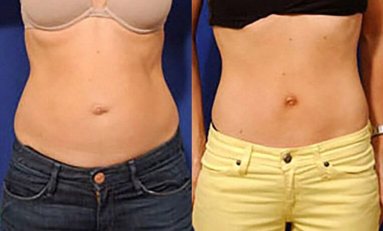 Hybrid abdominoplasty with liposculpture of flanks.