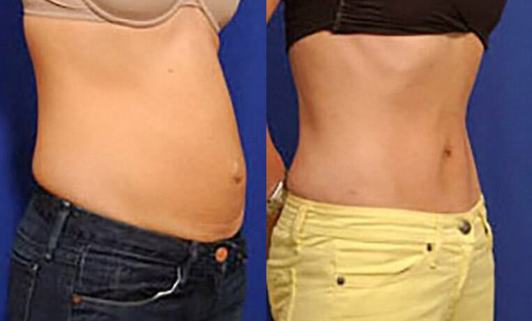 Hybrid abdominoplasty with liposculpture of flanks.