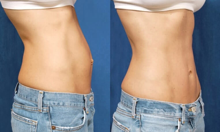 Hybrid abdominoplasty with liposculpture of flanks.