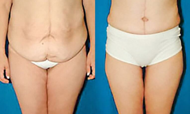 Abdominoplasty with flank extention, thighlift and liposuction