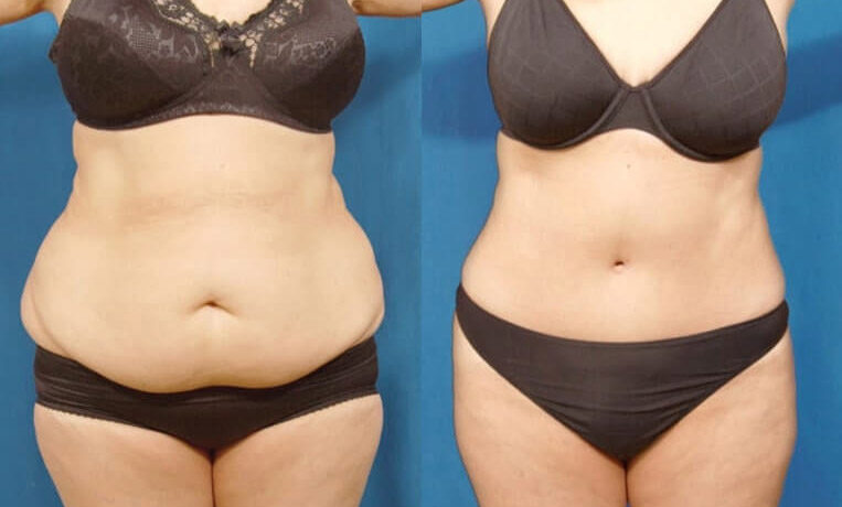 Full abdominoplasty with liposuction to flanks, abs, and waist.