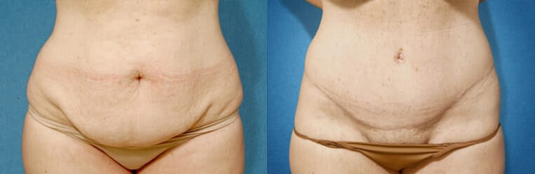 Tummy Tuck with Flank Extension, Diastasis Repair, Liposuction to Abdomen and Flanks