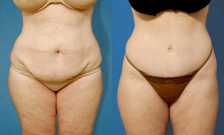 Tummy Tuck with Flank Extension, Diastasis Repair, Liposuction to Abdomen and Flanks