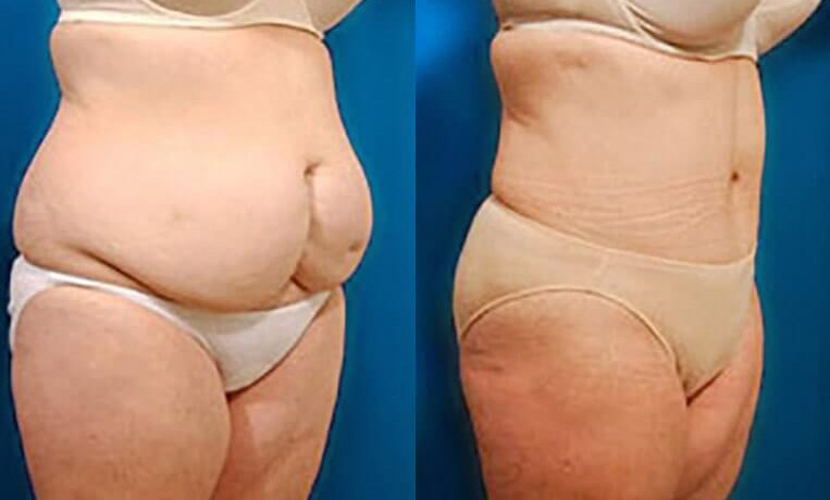 Abdominoplasty with flank extension, liposuction of waist and abodomen.