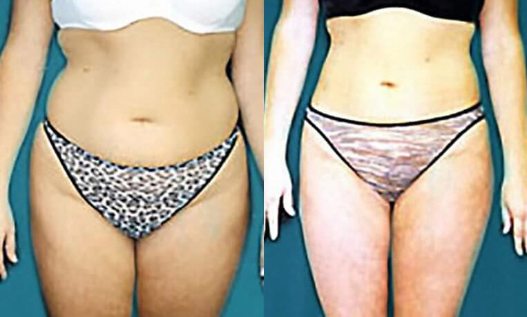 Liposuction to abdomen, waist, flanks, inner/outer thighs.