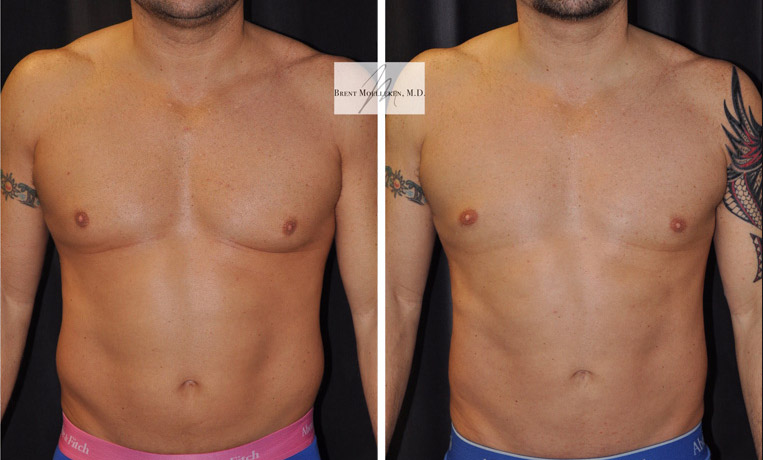 Liposuction to Abdomen, Flanks, Chest and Lateral Chest