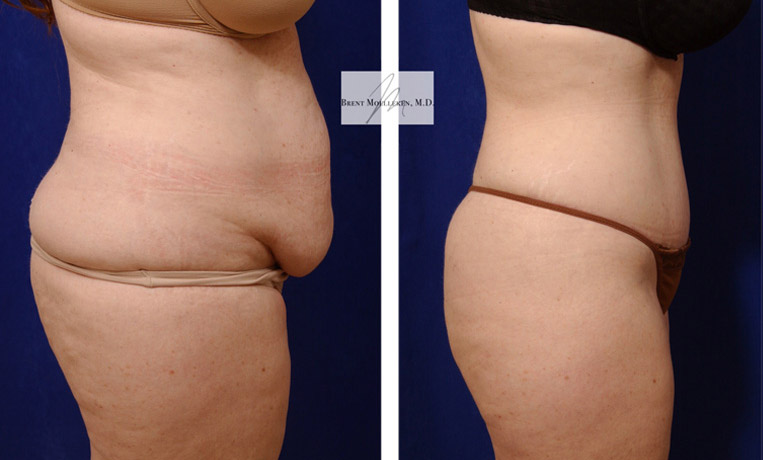 Tummy Tuck with Flank Extension, Diastasis Repair, Liposuction to Abdomen and Flanks