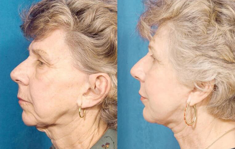 Facelift with Necklace, USIC Cheeklift, Upper Blepharoplasty, Lateral Browlift, Livefill to Nasolabial Folds and Lips, Upper Lip Lift, Co2 Laser Resurfacing