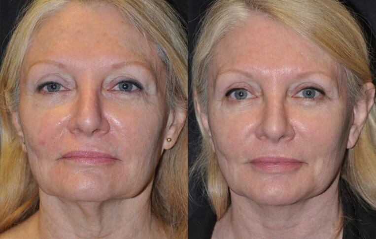 Facelift with Necklace © and upper blepharoplasty.