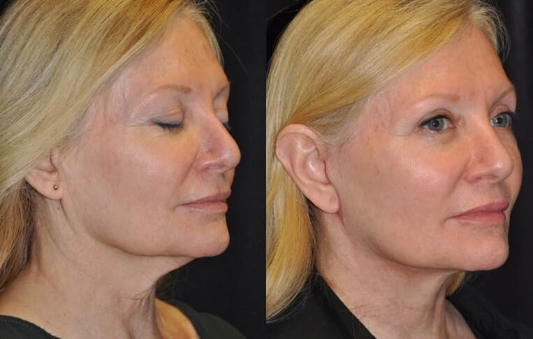 Facelift with Necklace © and upper blepharoplasty.