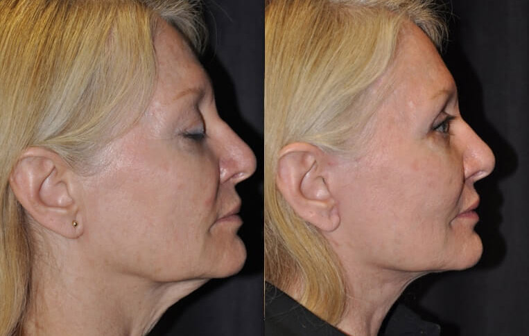 Facelift with Necklace © and upper blepharoplasty.