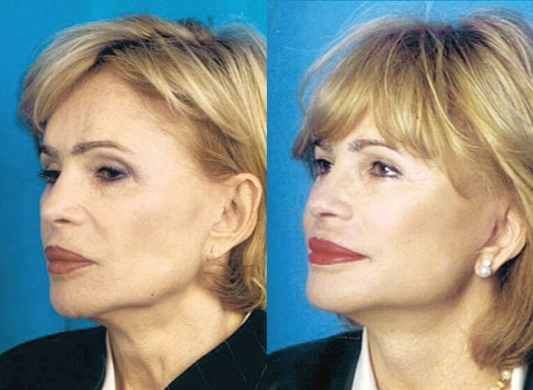 Revision Facelift